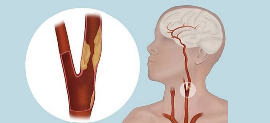 Carotid Endarterectomy in Pune